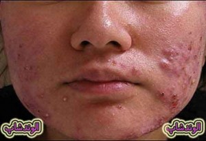 درمان خانگی آکنه