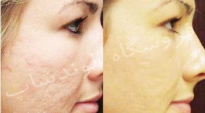 درمان خانگی جوشها