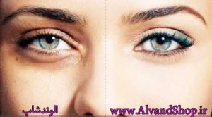 علل سیاهی دور چشم